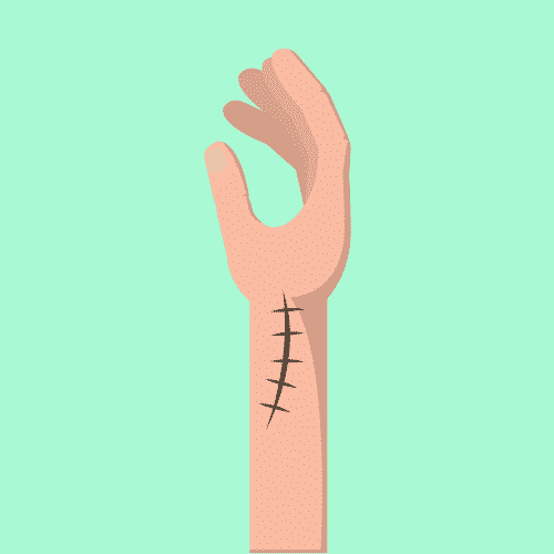 Permanent Scar Compensation: Making a Claim